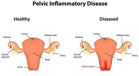 Pelvic