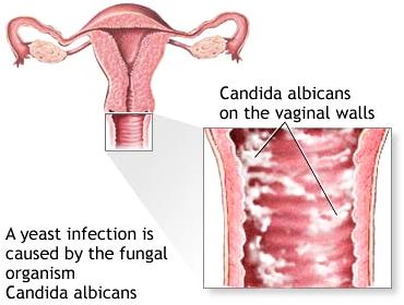 candidiasis